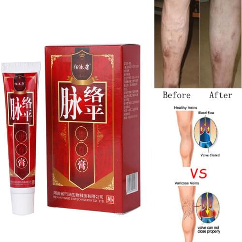 Varicose Veins Treatment Cream Ointment Vasculitis Phlebitis Spider Veins Pain Varicosity Angiitis Remedy Removal Herbal Cream