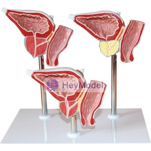 HeyModel Prostate seizure pathological model of the prostate