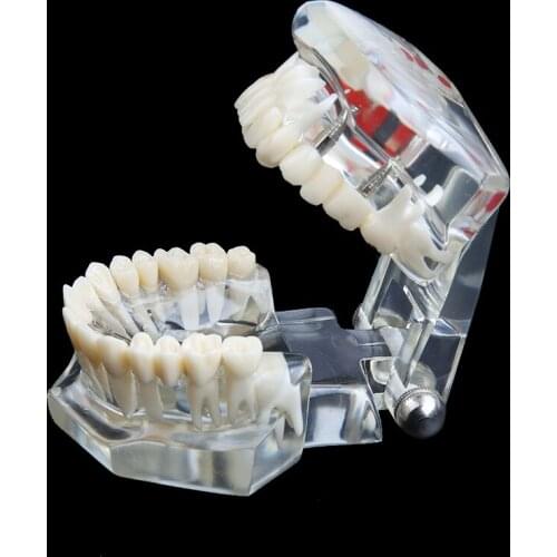 1pcs Dental Oral Hygiene Implant Disease Teeth Model for Medical Teaching PVC/resin Oral Health Care Teeth Whitening Teeth Model