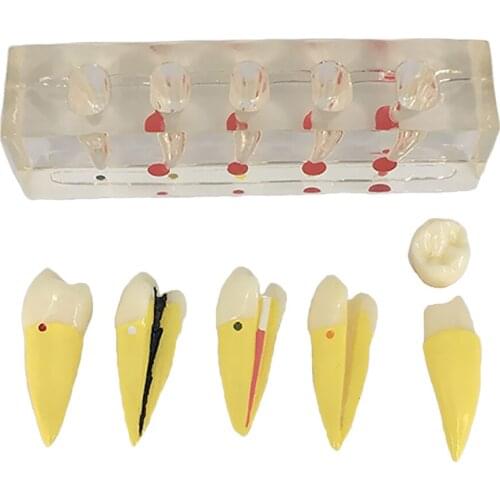 Teeth Pulp Disease Clinical Model for Teeth Teaching Learning