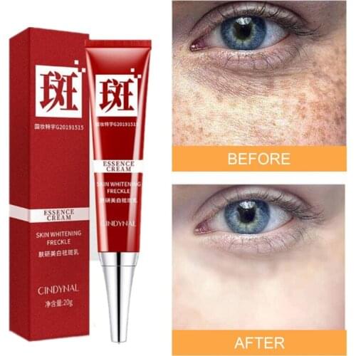 Whitening Freckle Cream Remove Face Skin Care Chloasma Remove Dark Spots Melanin Melasma Cream whitener Brighten Skin Anti-Aging