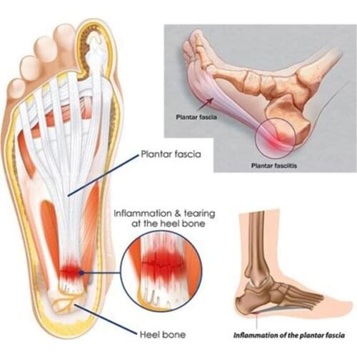 Adjustable Plantar Fasciitis Night Splint Sport Pain Toe Foot Brace Support MH88