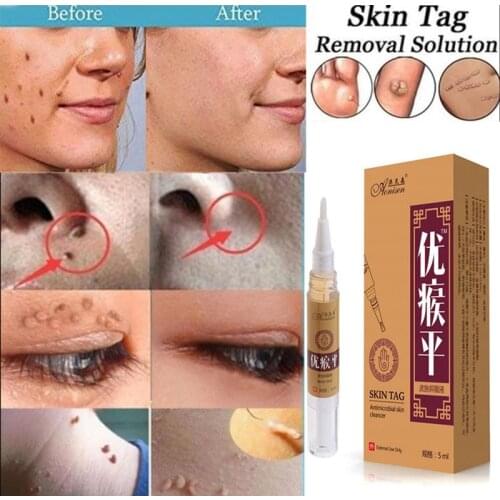 5ml Genital Wart Treatment Papillomas Removal Of Warts Liquid From Skin Tags Removing Against Moles Remover Anti Verruca Remedy