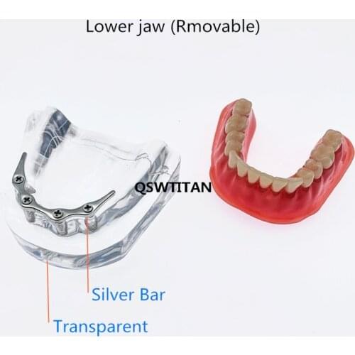 Teeth model with implant with Silver Bar Denture Repair Teeth mandibular Dental Teaching Model