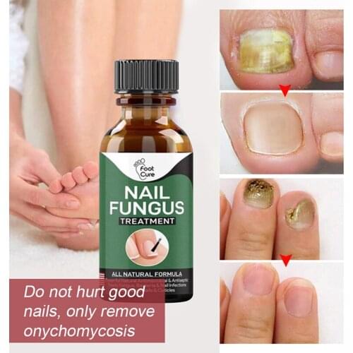 Nail Fungus Treatment Best Nail Repair Stop Fungal Growth Effective Nail Care Products