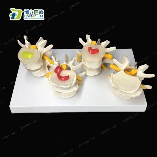 Human anatomy skeleton Spine 4 Stage Degenerative Lumbar Set Quadrilateral Lumbar Disease Model Medical Art