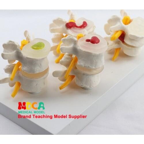 Human skeleton Department of orthopedics teaching spinal model lesion lumbar model medical teaching MYZ005