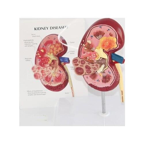 Kidney disease model urology kidney nephron glomerular kidney model renal anatomy model