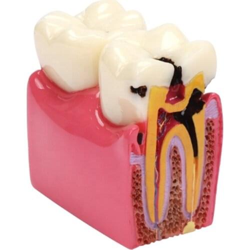 Dental Training Caries Model M4021 Compares Healthy and Caries Tooth Orthodontic/Dental Practice Teaching Model