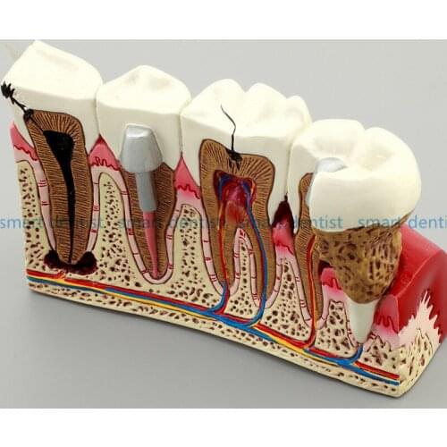 Good Quality Caries Tooth Model Dentist Patient Communication Anatomy Model Dentistry Rich Details Teaching Aids Equipment