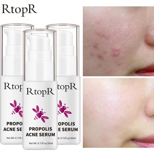 RtopR Acne Brightening Essence Acne Scar Repair Moisturizing Serum Shrinkage Elimination Acne Treatment Propolis Oil Control 3ps