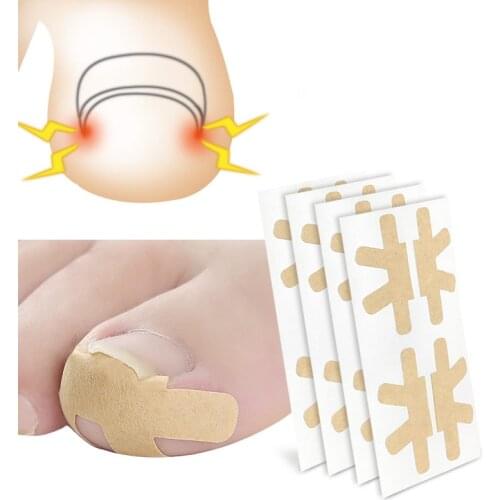1 Set Ingrown Nail Correction Patch Paronychia Treatment And Repair Foot Care Tools To Prevent Nails From Growing In The Flesh
