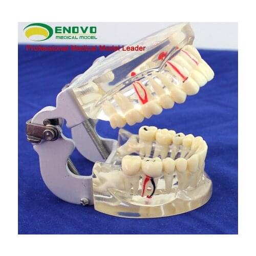 Transparent adult comprehensive oral pathology model dental model periodontal disease dental caries demonstration model