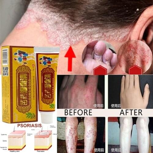 2 Piece Health Care Skin Fungus Anti Bacterial Cream Natural Chinese Herbs Cream Onitment for Psoriasis Dermatitis Eczema Treatm