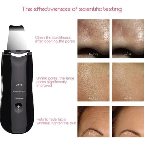 Ultrasonic Skin Scrubber Vibration Face Spatula Blackhead Remover Facial Scrubber Shovel Clean Cavitation Peeling Facial Lifting