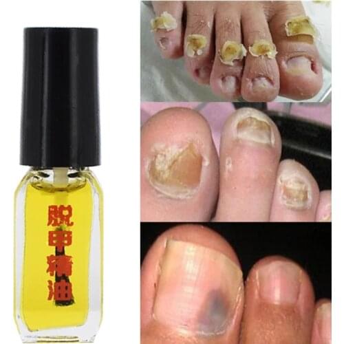 3PCS Removal of fungus essence fungus nail treatment bright nail repair anti-infective foot care onychomycosis