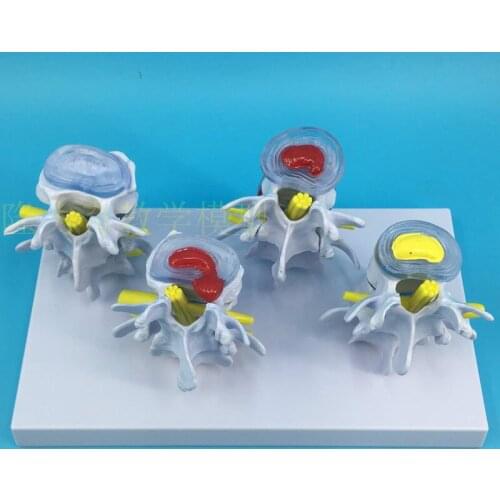 Four stage lumbar model Bone pathological model Spine Disc herniation and deformation