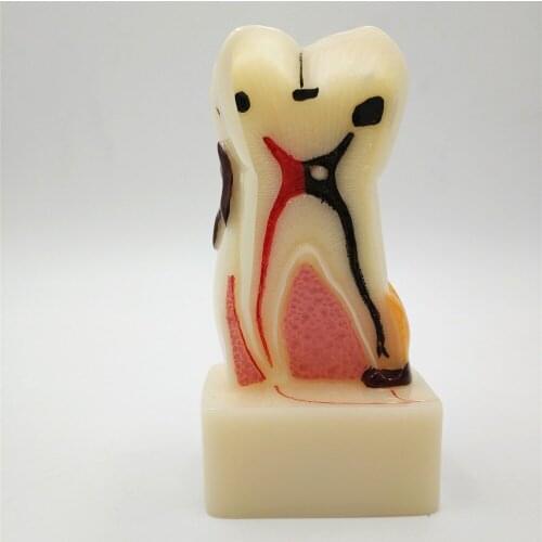 Dental pathology model anatomical model teeth model dental caries gum show for Dental Teeth Models 2018