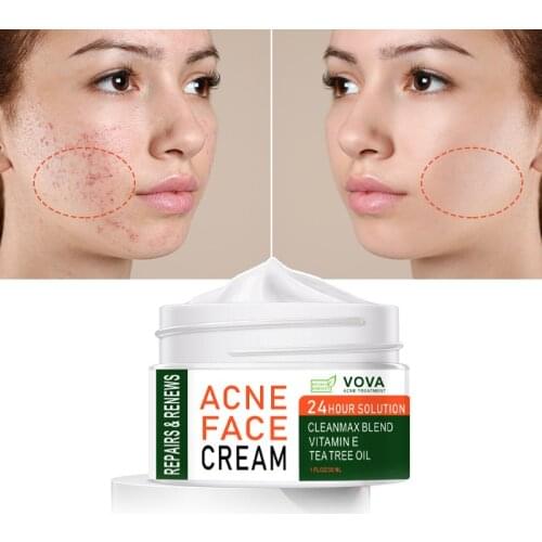 VOVA Effective Acne Removal Cream Acne Treatment Fade Acne Spots Oil Control Shrink Pores Whitening Moisturizing Skin Care 30ml