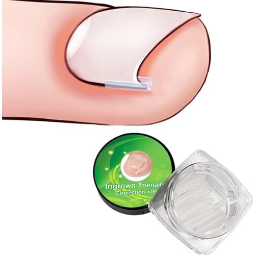 10pcs/box Ingrown Nail Pad Nail Filling Nail Groove Pad Ingrown Toenail Corrector Ingrown Nail Artifact