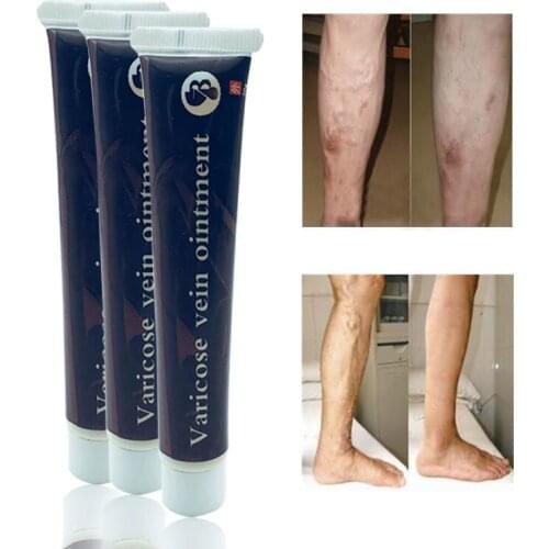 Varicose Veins Treatment Cream Effective cure Varicosity Angiitis ointment Health Care Vasculitis Phlebitis Spider Veins Pain