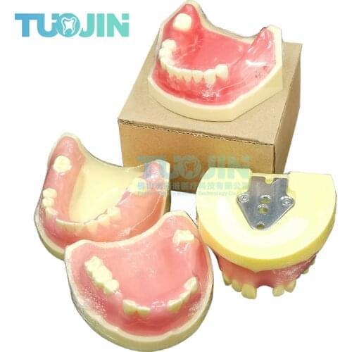 Dental Implant Tooth Model Restoration Disease Analysis Demo Study Teeth Modeling Dentistry Planting Training Teaching Tools