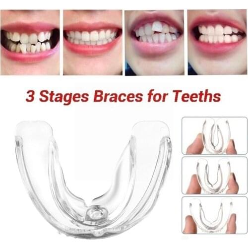 Orthodontic Braces Dental Braces Smile Teeth Alignment Silicone Teeth Mouth Retainer Guard Tooth Braces Instanted Trainer T G3H3
