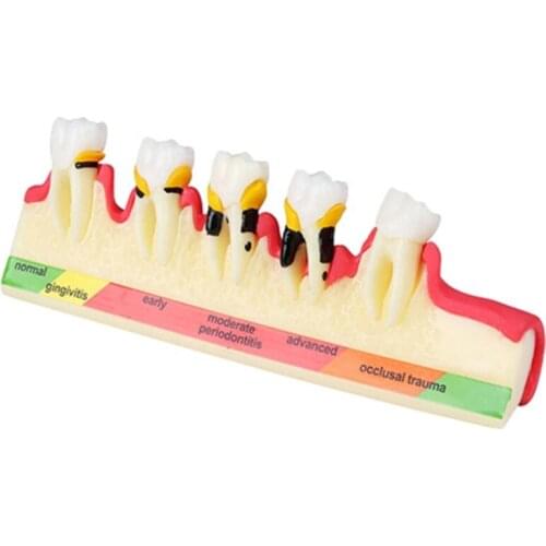 Periodontal Disease Teeth Model/Dental Disease Model M4010 Caries Model Demonstrates the progress of Periodontal disease M4010