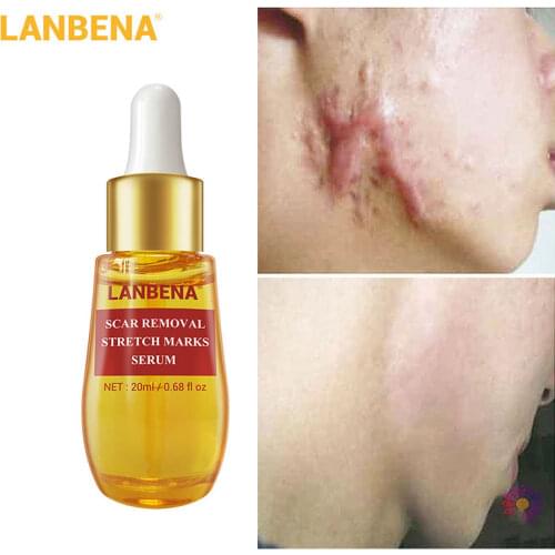 LANBENA Acne Scar Remove Serum Fade Scar Melanin Remover Pockmark Surgery Wounds Bburns Hyaluronic Acid Moisturizing Skin Care