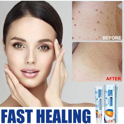 Warts Remover Ointment Skin Tag Remover Thorn Pain Relief Cream Antibacterial Treatment Herbal Extract Patch Medical Plaster