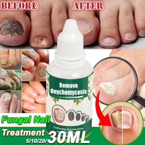 30ml Fungal Nail Treatment Serum Onychomycosis Paronychia Anti-Fungal Nail Infection Herbal Toe Fungus Foot Repair Essen