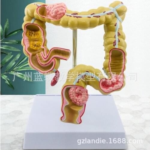 1/2 Life Size Human Rectal Pathology Colon Model Large Intestine Model Anorectal Anatomical Model Tools