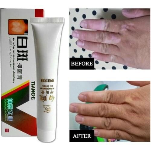 Medical White Spot Disease Cream Pigment Melanin Promoting Liniment Skin Vitiligo Leukoplakia Disease Treatment plaster