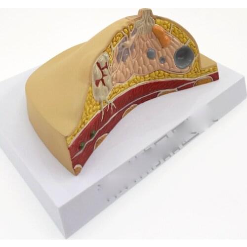 Anatomical Human Pathological Breast Model Medical Disease & Cancer Anatomy for Patient Education Teaching Resources