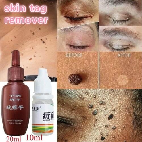 Skin Tag Remover Genital Wart Treatment 12 hours Medical kill Remover Skin Tag Mole & Genital Wart Remover Foot Corn Removal