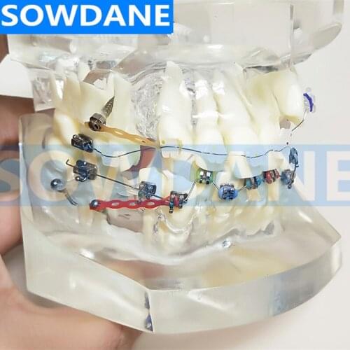 Transparent Dental Orthodontic Mallocclusion Model with two kinds of Brackets Archwire buccal tube for Patient Communication