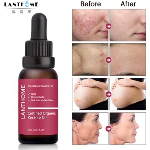 NEW 100% Pure All Natural Organic Rosehip Seed oil Cold-Pressed Unrefined Effectively fade-out acne print Essence cleaning face