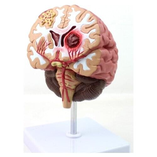 1:1 Humans Brain Disease Model Brain Anatomical Model Neurosurgery Cerebral Hemorrhage Brain Pathological Medical Teaching Model