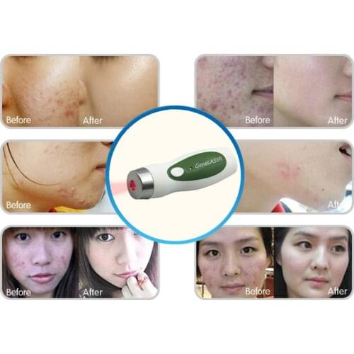 Dual laser light therapy Device Scars Acne Remover Facial Beauty Skin Care no pain no side effect