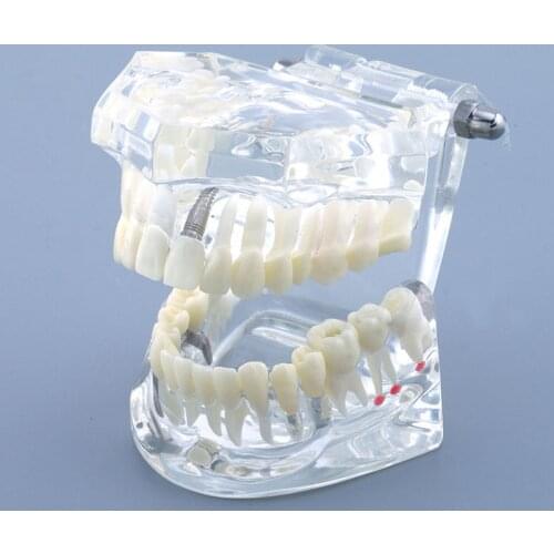 Dental Teeth Model M2001 Implant and Restoration Model