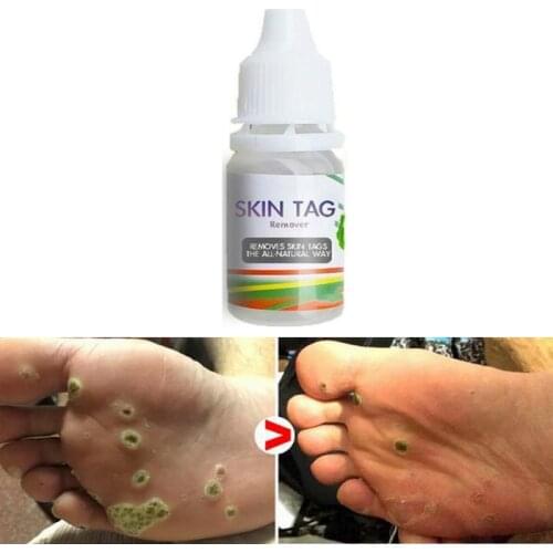 Chinese Medicine Treatment Skin Warts Removal Foot Corn Removal Plantar warts Pomada De Verruga Skin Care Medical Ointment