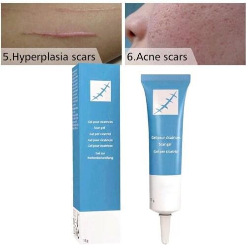 15g Scar Removal Cream Acne Scars Gel Stretch Marks Surgical Acne Scar Pigmentation Burn For Body Care Spots Corrector Repa U8A9