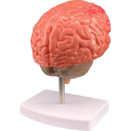 Simulation of human brain disease model Brain anatomy Neurology Neurology Encephalopathy Brain lesions model