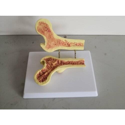 Human Skeleton Normal and Diseased Femoral Head Comparison Anatomy Model