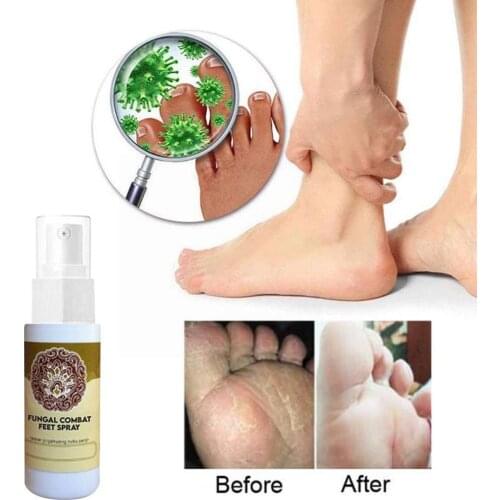 Anti-fungal Infection Foot Sterilization Spray Disinfection Itching To Erosion Relieve Peeling Feet Itchy Blisters X5J5