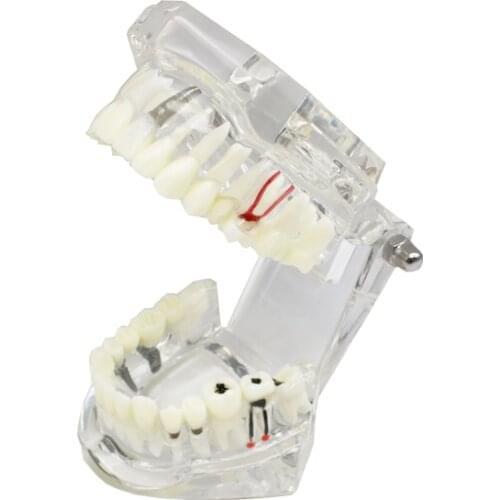 2 pcs Dental model Implant Disease Teeth Model for Medical Teaching PVC With Restoration Tooth implant dentales dental implant