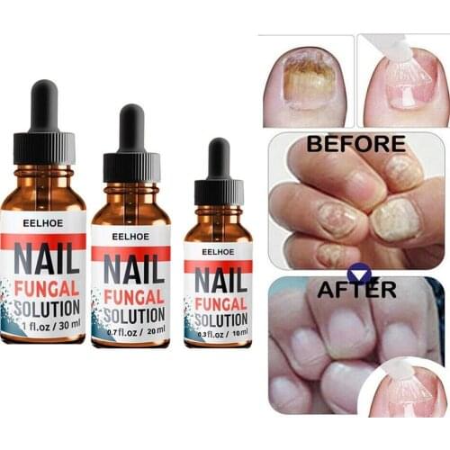 30ml Fungal Nail Treatment Pen To Remove Onychomycosis Fungal Paronychia Liquid Healthy Polish Tool Anti Care Nail K5B2