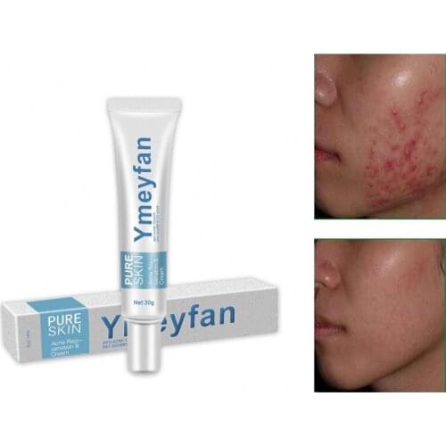 Wholesale 200pcs/Lot YMEYFAN Anti Acne Scar Removal Cream Whitening Moisturizing Shrink Pores Face Back Skin Care For Men Women