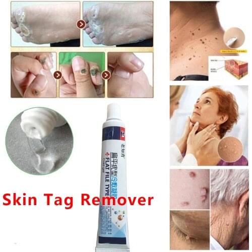 Skin Tags Removing Against Moles Remover Skin Care Tools Remover Genital Wart Treatment Papillomas Removal of Warts Liquid From
