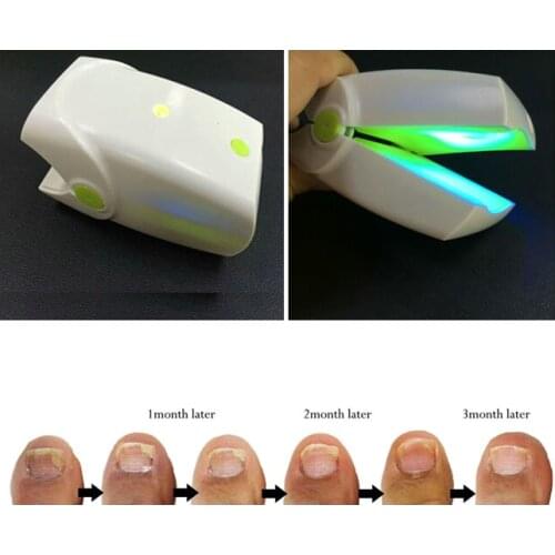 Hot Selling Painless Nail Fungus Laser Device With 905nm Laser For Nail Fungus Treatment, Laser For Onychomycosis